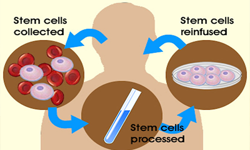  Autologous Transplant