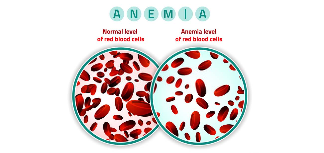 Anaemia