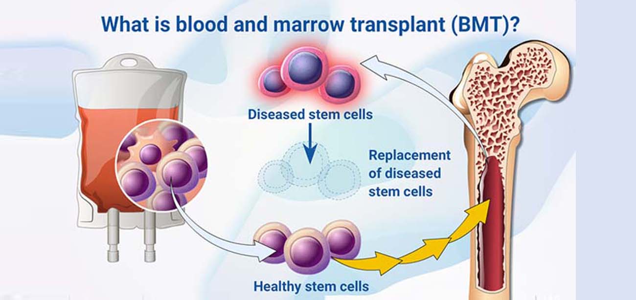 Bone Marrow Transplantion