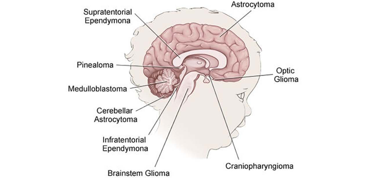 Brain Tumors