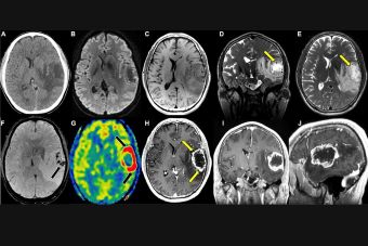 Low-Grade Glioma Treatment