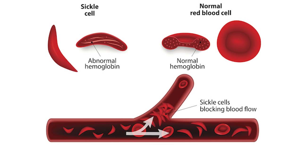 Hereditary Blood Disorder