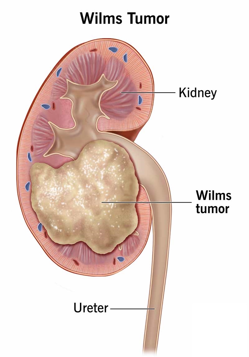 Wilms tumors